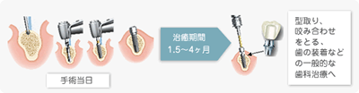 インプラント治療について