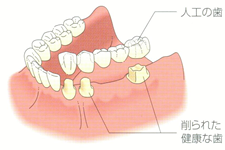 隣接する歯を1、2本失った場合