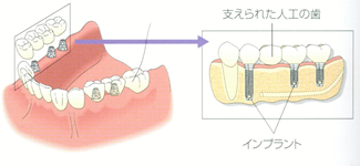奥歯を含めて複数の歯を失った場合
