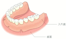 全ての歯を失った場合