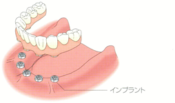 全ての歯を失った場合