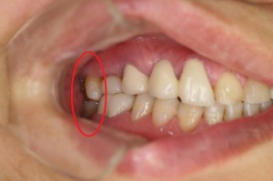 右奥歯のインプラント被せ物装着後の写真