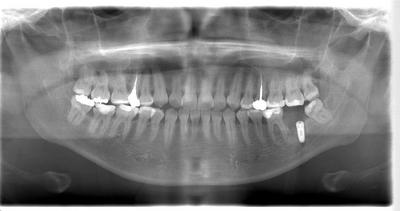 インプラント埋入後レントゲン