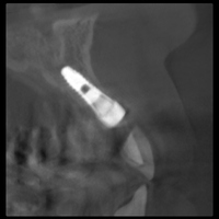 術後のＣＴ（前歯部の骨の断面図）