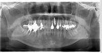 インプラント埋入後のレントゲン写真