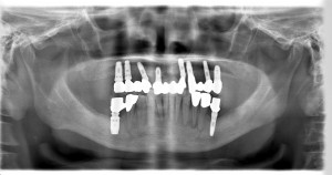 被せ物装着後レントゲン