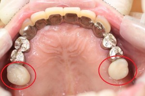 被せ物装着後の口腔内写真(上あご) 被せ物装着後の口腔内写真(上あご)