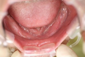 術前の口腔内写真(下あご) 術前の口腔内写真(下あご)