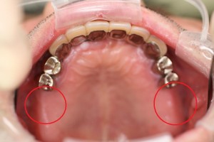 術前の口腔内写真(上あご) 術前の口腔内写真(上あご)